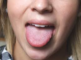 sore tongue 15 possible causes