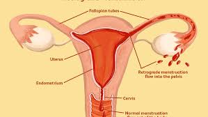 Endometriosis is a condition wherein the cells that form. Retrograde Menstruation Symptoms Causes And Diagnosis