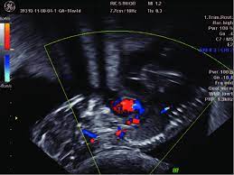 amenorrhea color doppler ultrasound