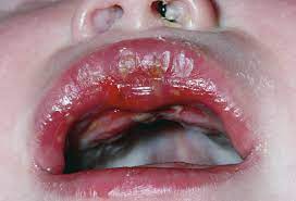 Oral herpes involves the face or mouth. Herpes Simplex Virusinfektion Bei Neugeborenen Padiatrie Msd Manual Profi Ausgabe