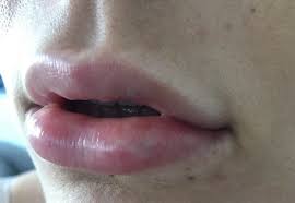 blocked blood vessel after lip filler