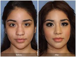 Maybe you would like to learn more about one of these? Ethnic Rhinoplasty Brings Rhinoplasty To People Of All Backgrounds And Heritage Add Crazy