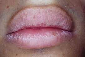 exfoliative cheilitis