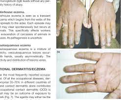29 a b hand dermais eczema
