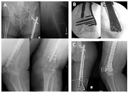 geriatric trochanteric hip fractures