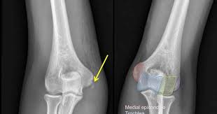 Medial epicondyle entrapment after an acute fracture dislocation of the elbow is a common finding in the pediatric population, but a rare finding in adults. Rit Radiology Medial Epicondyle Fracture Of The Humerus