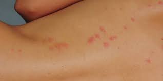 bed bug bites what do they look like
