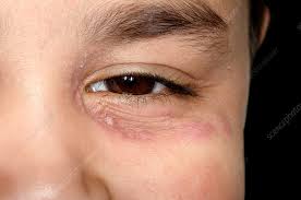 herpes infection around the eye stock