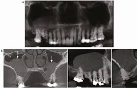 the role of cbct in implant dentistry