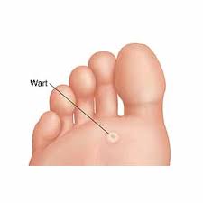 plantar warts ce foot ankle clinic