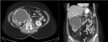 A 64 Year Old Woman With A Renal Cystic Neoplasm Renal And
