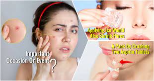 7 remes to get rid of blind pimples