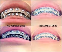 These position of the rubber bands on the brackets also helps in correcting overbite and underbite overtime. Friendly Reminder To Wear Your Elastics Sharing My One Month Progress With My Triangular Elastics I Started Wearing Triangular Elastics Last November To Fix My Overbite And It S Working Braces