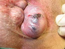 Image result for hemorrhoids