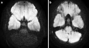 unexpected mri artifacts experience