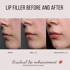 lip filler and gradual lip enhancement