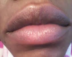 dark lip bleaching to get pink lips