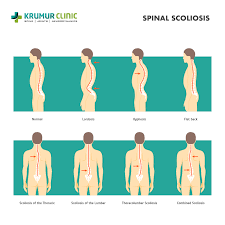 scoliosis spinal curvature