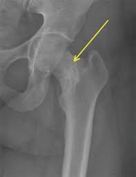 stress fractures of the femur