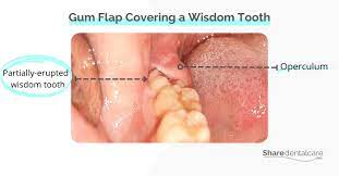 wisdom tooth gum flap share dental care