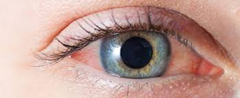 red eyes treatment in delhi main