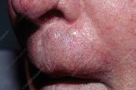 basal cell carcinoma above lip stock