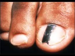 are black toenail lines streaks safe
