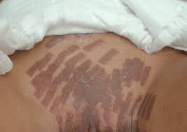 area after laser hair removal