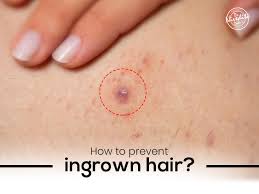 how to prevent ingrown hair