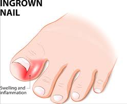 what to soak ingrown toenail in dyi