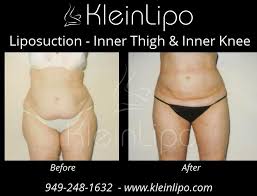inner thighs liposuction kleinlipo