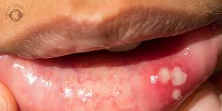 mouth ulcers in kids causes symptoms