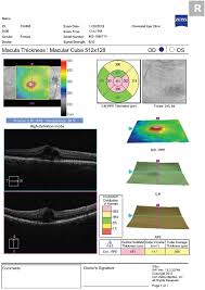 detecting pseudophakic cystoid macular