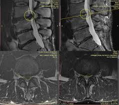 how to heal a herniated disc naturally