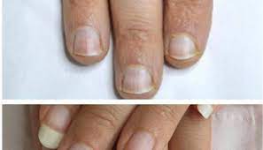 and disadvanes of gel nails