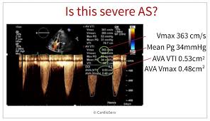 Aortic Stenosis And Mismatch Values