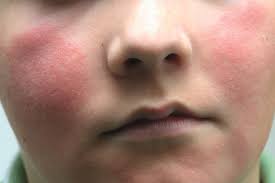 rashes in children the pharmaceutical