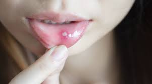 mouth sores types causes symptoms