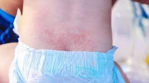 rashes in kids age by age skin