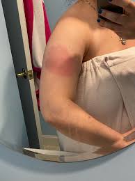 I got the moderna vaccine, and the initial reaction was just a little soreness in the injection site, reinprecht said. Yahoo News On Twitter Covid Arm Rash Seen After Moderna Vaccine Annoying But Harmless Doctors Say Https T Co Yy7lhenfmw