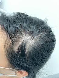 promote hair regrowth
