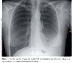 The most common symptoms of mesothelioma include chest or abdominal pain, shortness of breath, fatigue and collapse of the lung. Artikel 207601