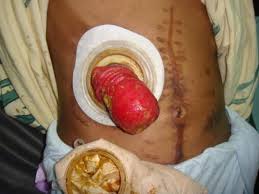Image result for colostomy