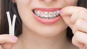 benefits of dental wax for braces how