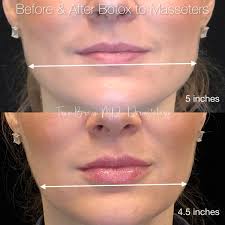Botox for tmj may not be covered by insurance because it is not fda approved. Botox For Teeth Grinding Tmj Disorder Facial Slimming Houston Tx Dermatologist
