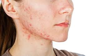 how to reduce redness from acne