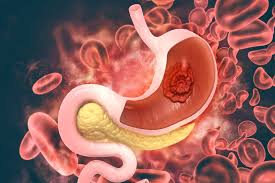 Inflammatory stomach diseases