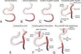 reversal of gastric byp a indicates