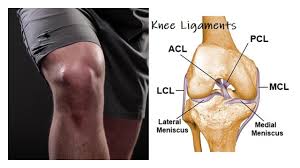 A popping sound when the injury is sustained. Knee Ligament Surgeries Aptiva Health