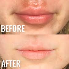 lip rash cheilitis eczema